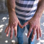 Porto Alegre confirma 1º caso de mpox em 2026 e faz alerta no Carnaval: ‘Evitar contato