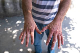 Porto Alegre confirma 1º caso de mpox em 2026 e faz alerta no Carnaval: ‘Evitar contato