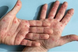 Mpox pode matar? Saiba riscos e taxa de mortalidade da doença
