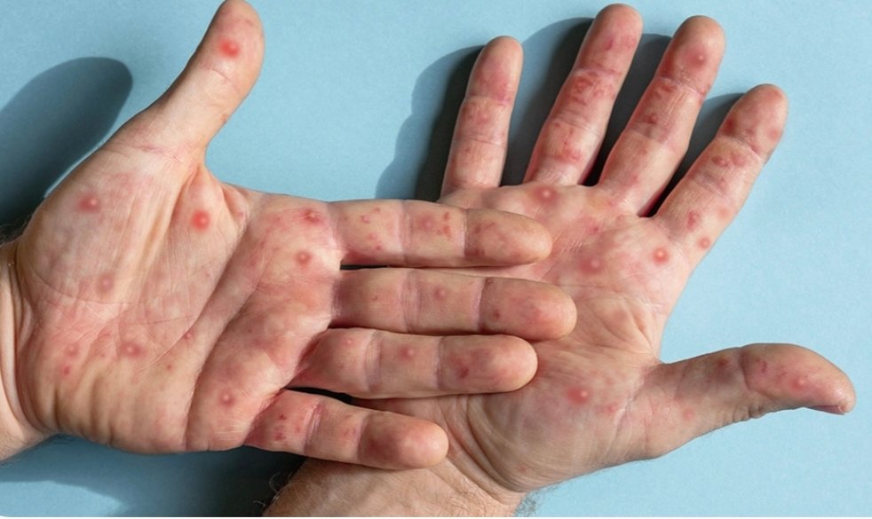 Mpox pode matar? Saiba riscos e taxa de mortalidade da doença